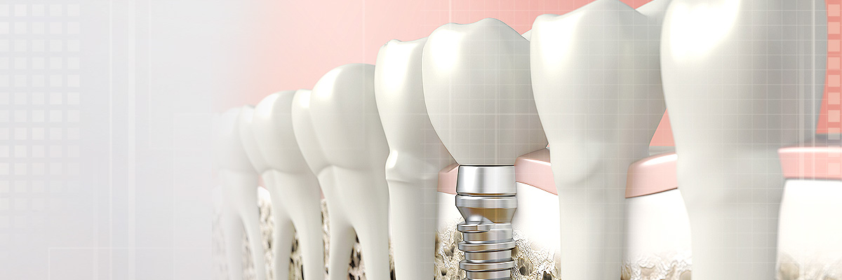Anaheim Dental Implants
