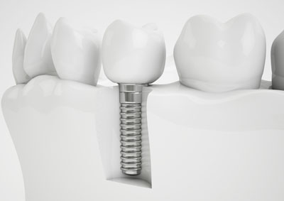 Dental Implants in Anaheim
