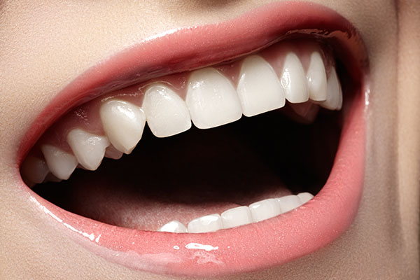 Dental Veneer in Anaheim