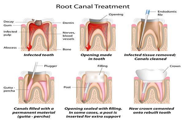 Root Canal