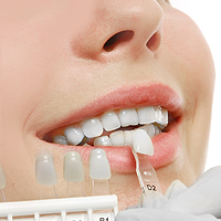 Dental Veneers and Dental Laminates